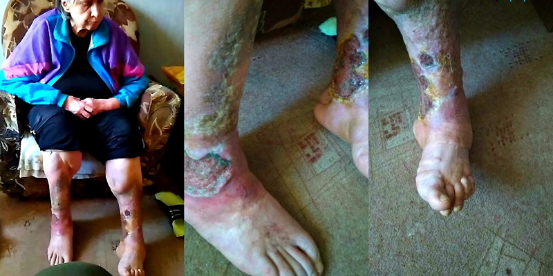 Одинокая пенсионерка в Пермском крае страдает от страшной болезни и нищеты — чиновники и врачи бездействуют