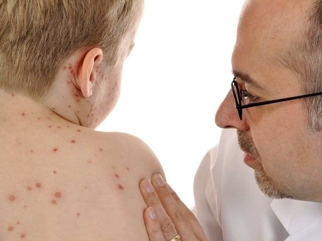 В Пермском крае зарегистрирован случай кори у непривитого ребенка